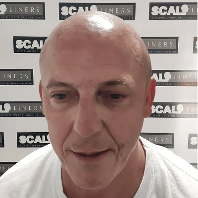 Wayne before scalp micropigmentation — receding hairline treatment Kent
