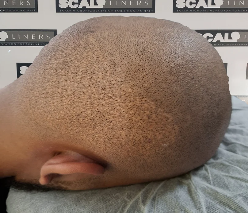 FUE hair transplant scar camouflage scalp micropigmentation Kent — scar concealment SMP result ScalpLiners Whitstable