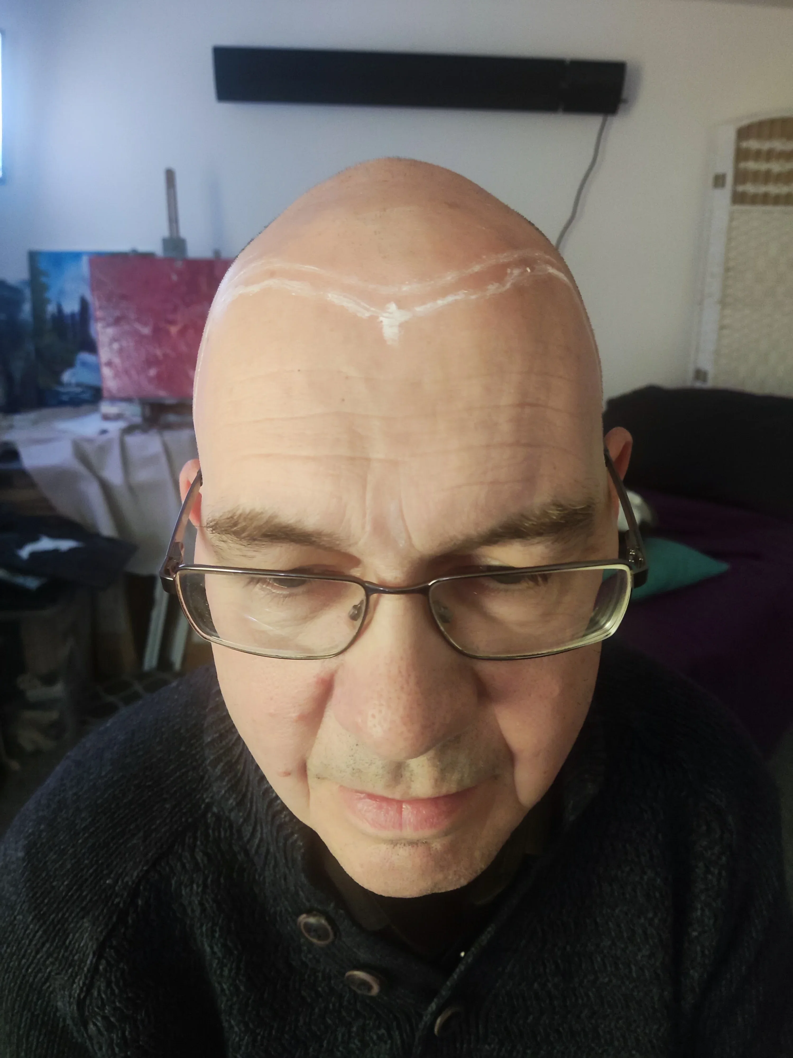 Chris scalp micropigmentation full head result Kent — before