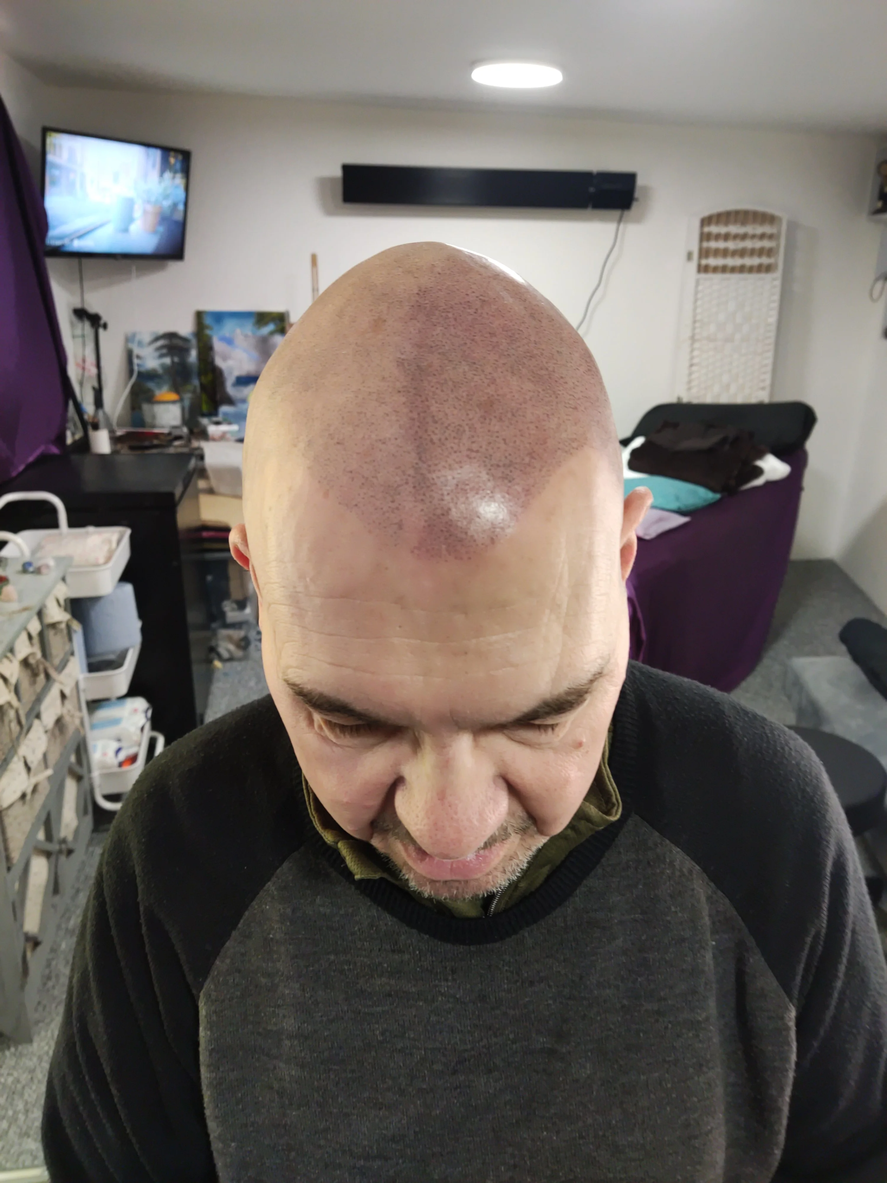 Chris scalp micropigmentation full head result Kent — session 2