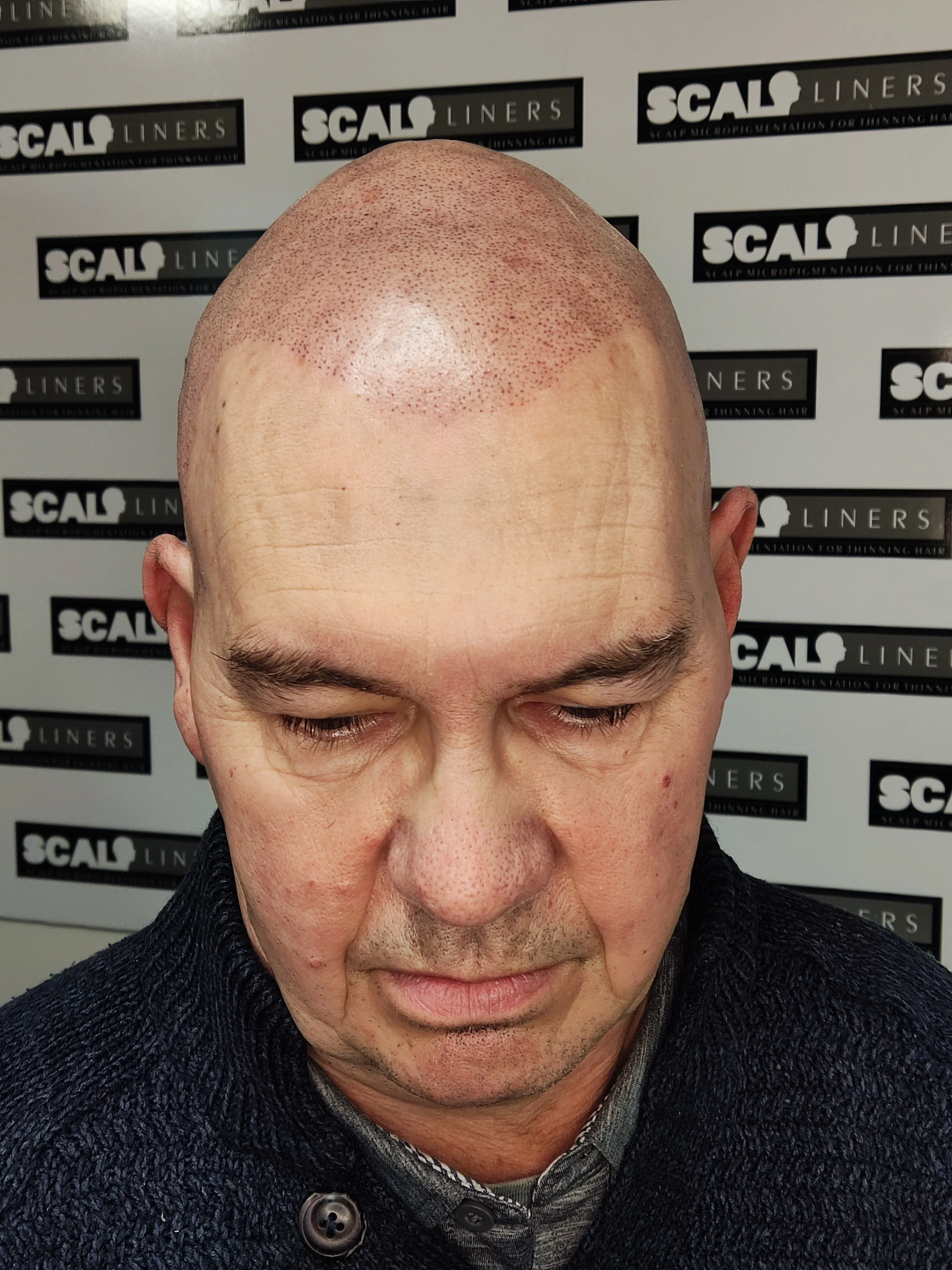 Chris scalp micropigmentation full head result Kent — session 4