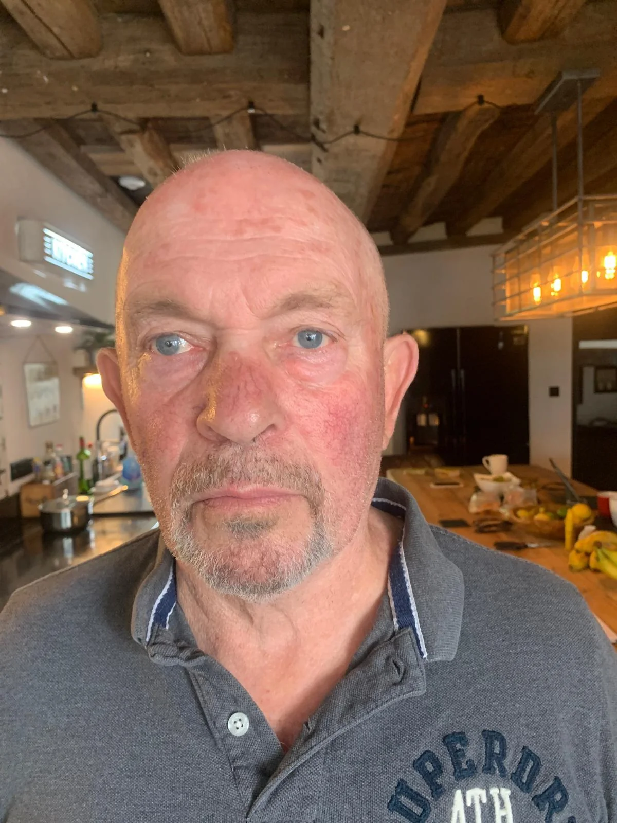 Craig full head SMP treatment ScalpLiners Kent — session 1
