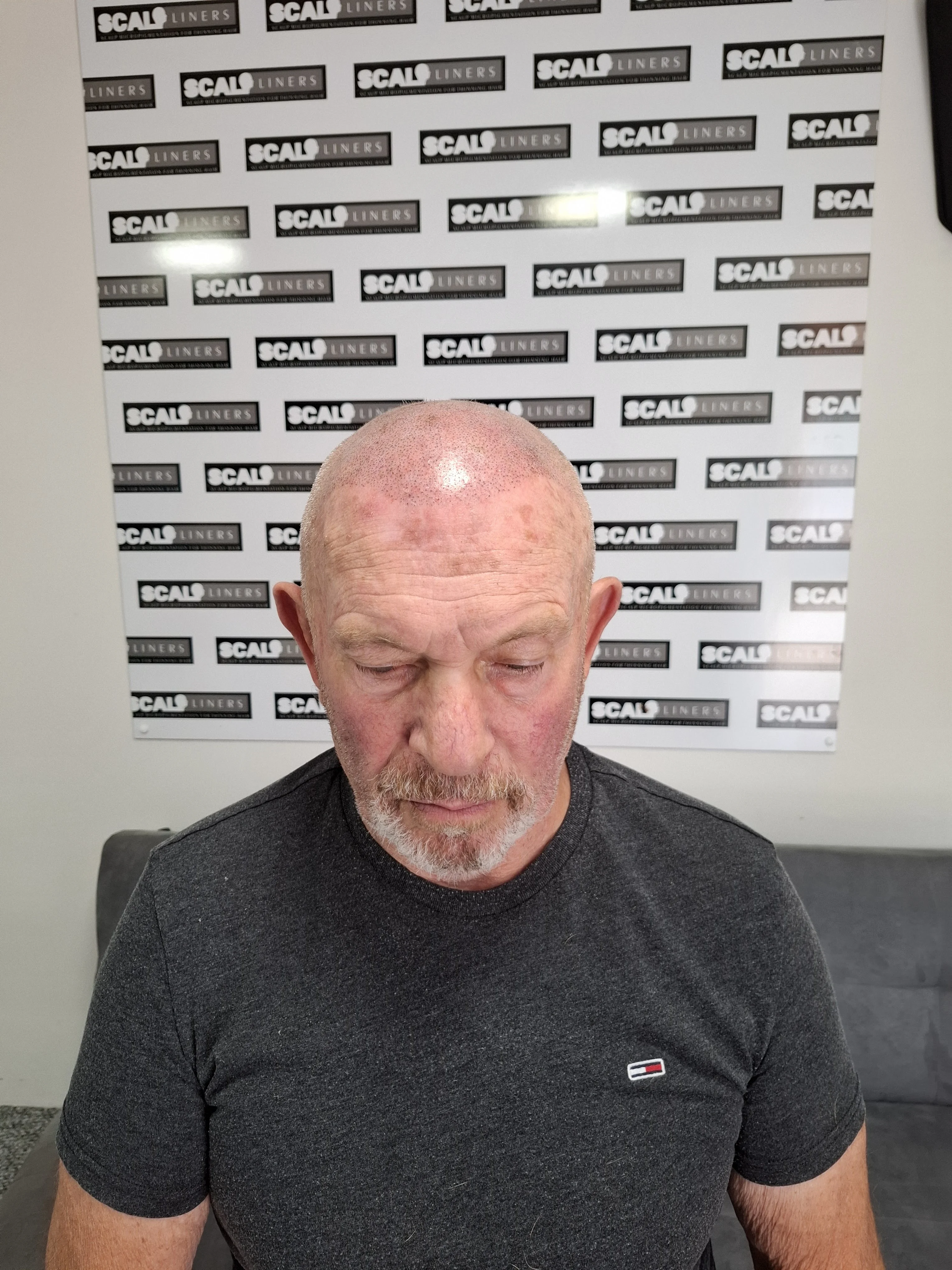 Craig full head SMP treatment ScalpLiners Kent — final result