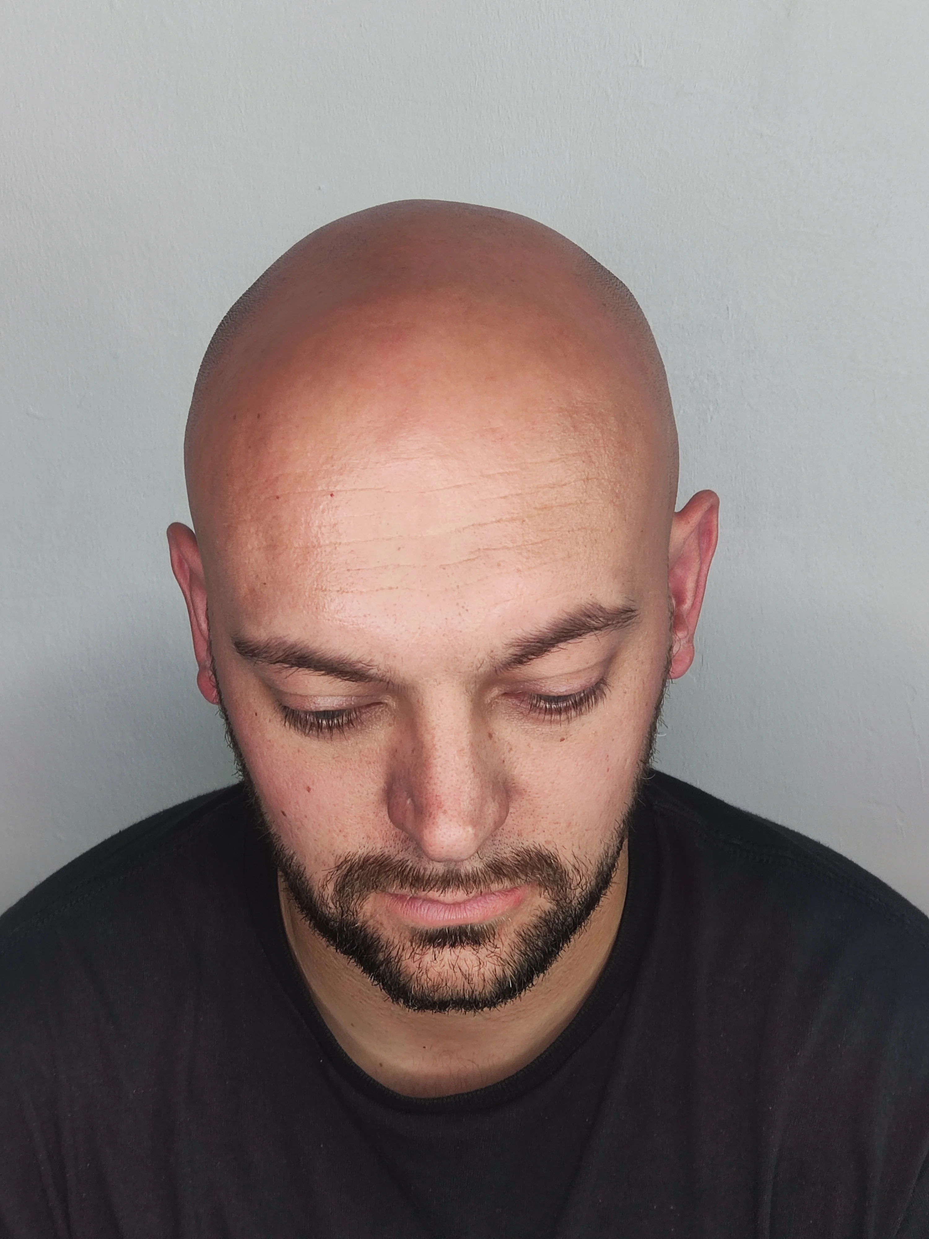 Gary scar camouflage scalp micropigmentation Kent — session 2