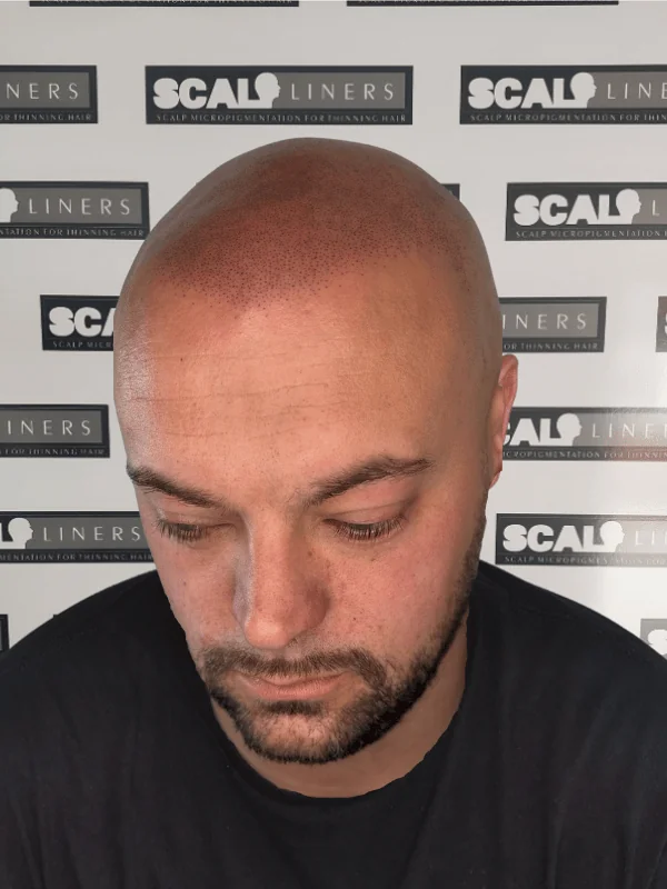 Gary scar camouflage scalp micropigmentation Kent — session 3