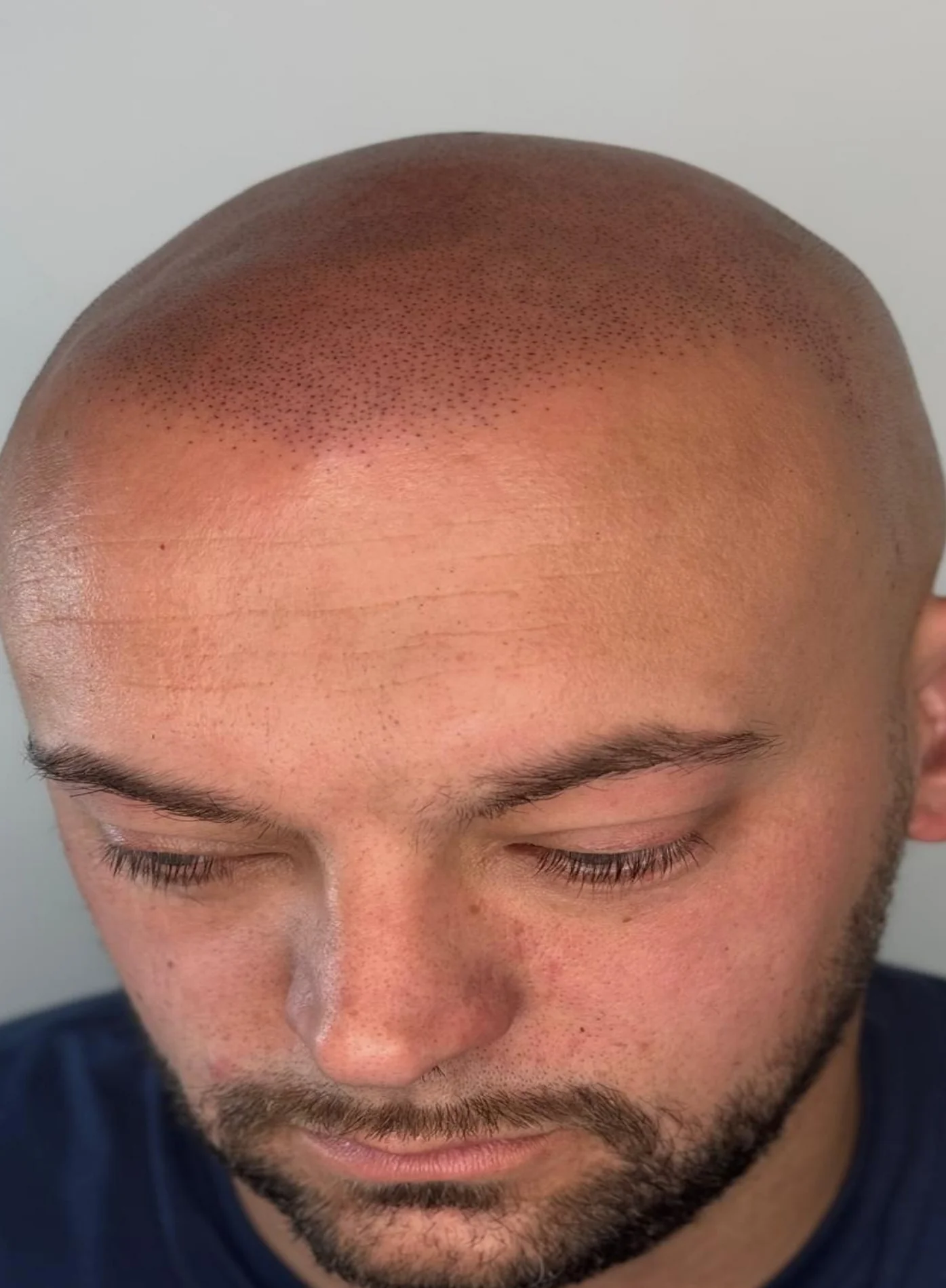 Gary scar camouflage scalp micropigmentation Kent — final result