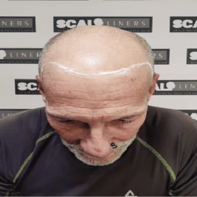Ian full head scalp micropigmentation result Kent — before