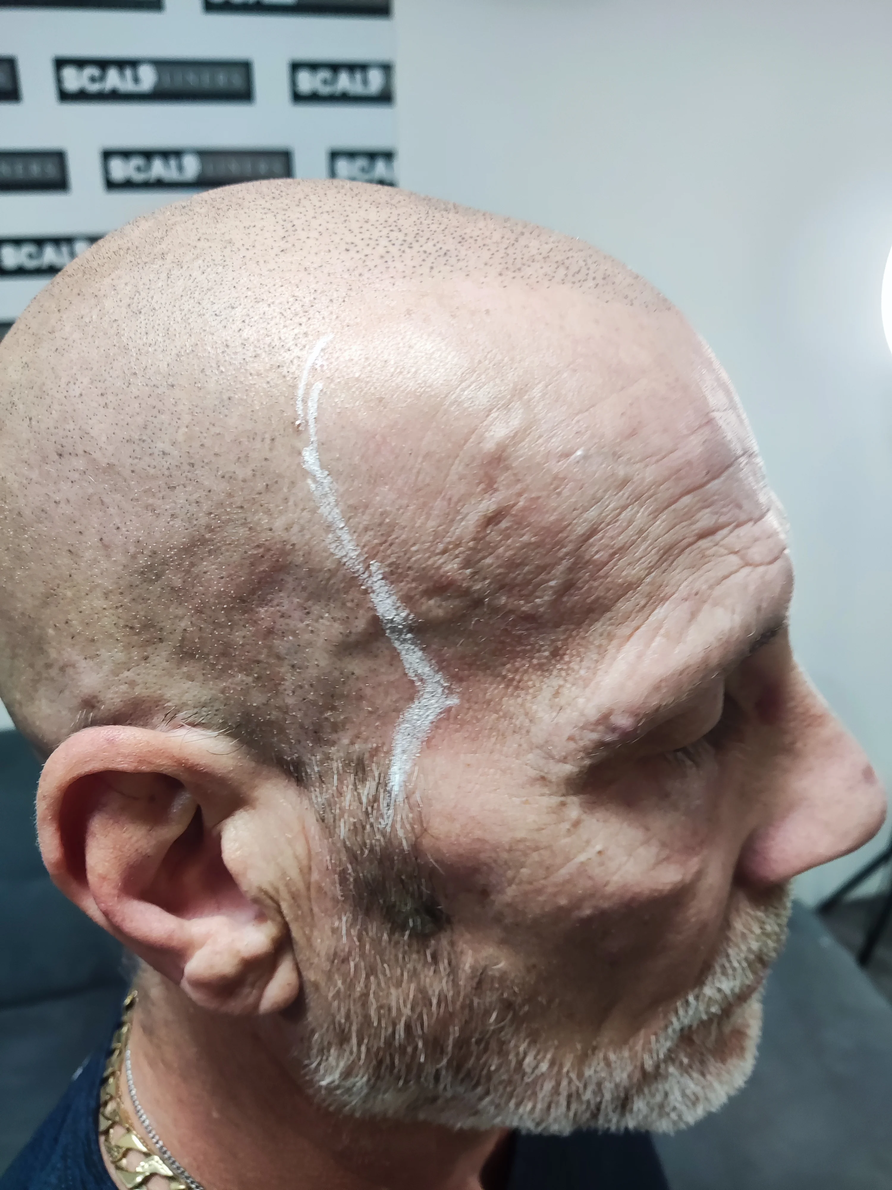 Ian full head scalp micropigmentation result Kent — session 2