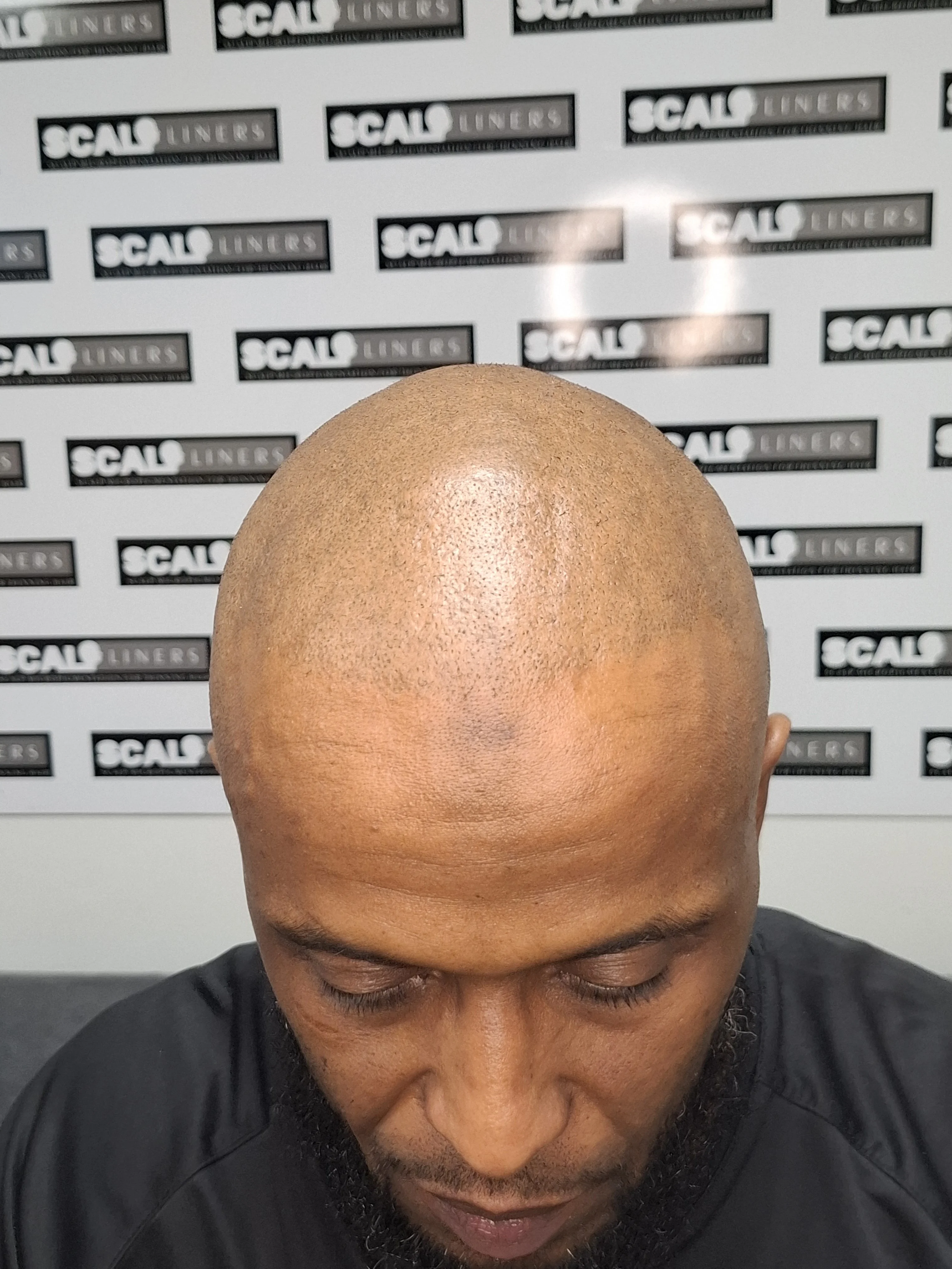 Mahammed full head scalp micropigmentation dark skin Kent — before