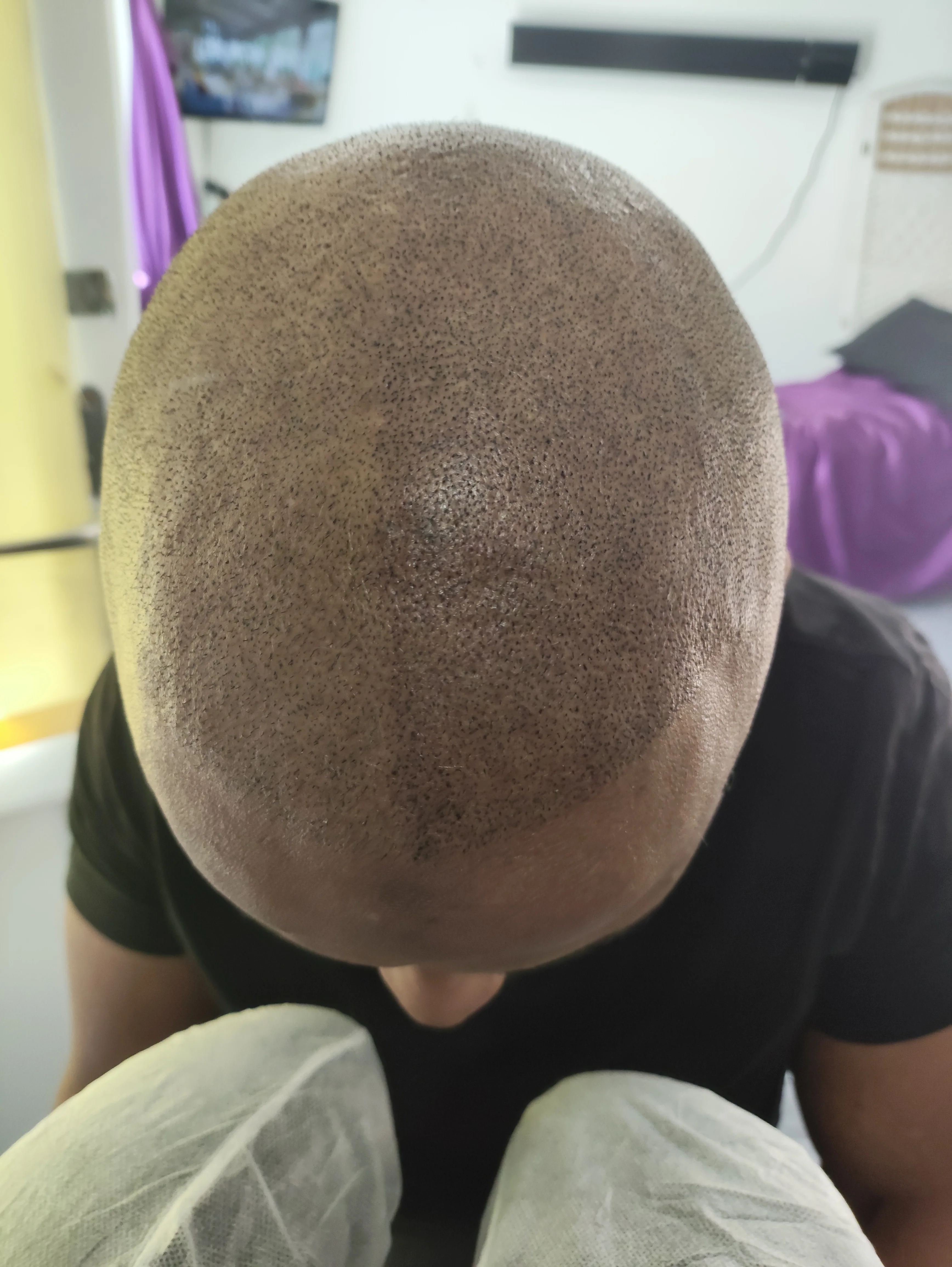 Mahammed full head scalp micropigmentation dark skin Kent — session 2