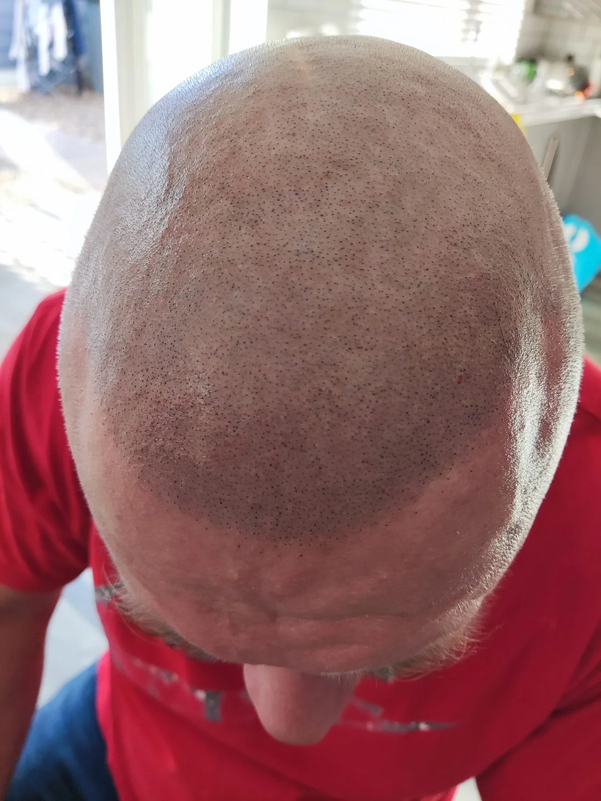 Mark Terrell ScalpLiners owner scalp micropigmentation Whitstable — before