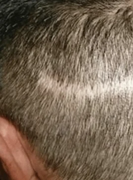 Mahammed scar camouflage final result scalp micropigmentation ScalpLiners Kent