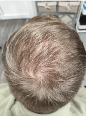 Tony scalp micropigmentation finished result Kent — before