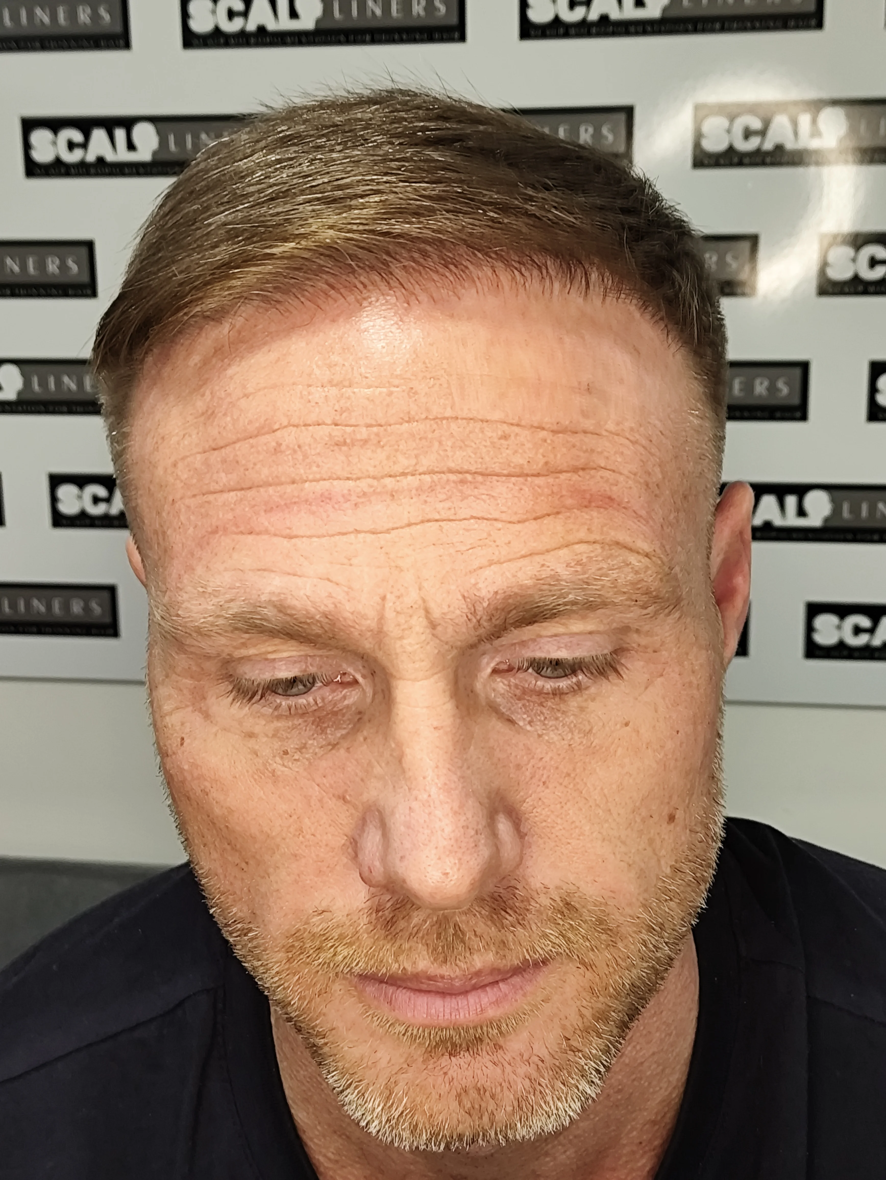Tony scalp micropigmentation finished result Kent — final result