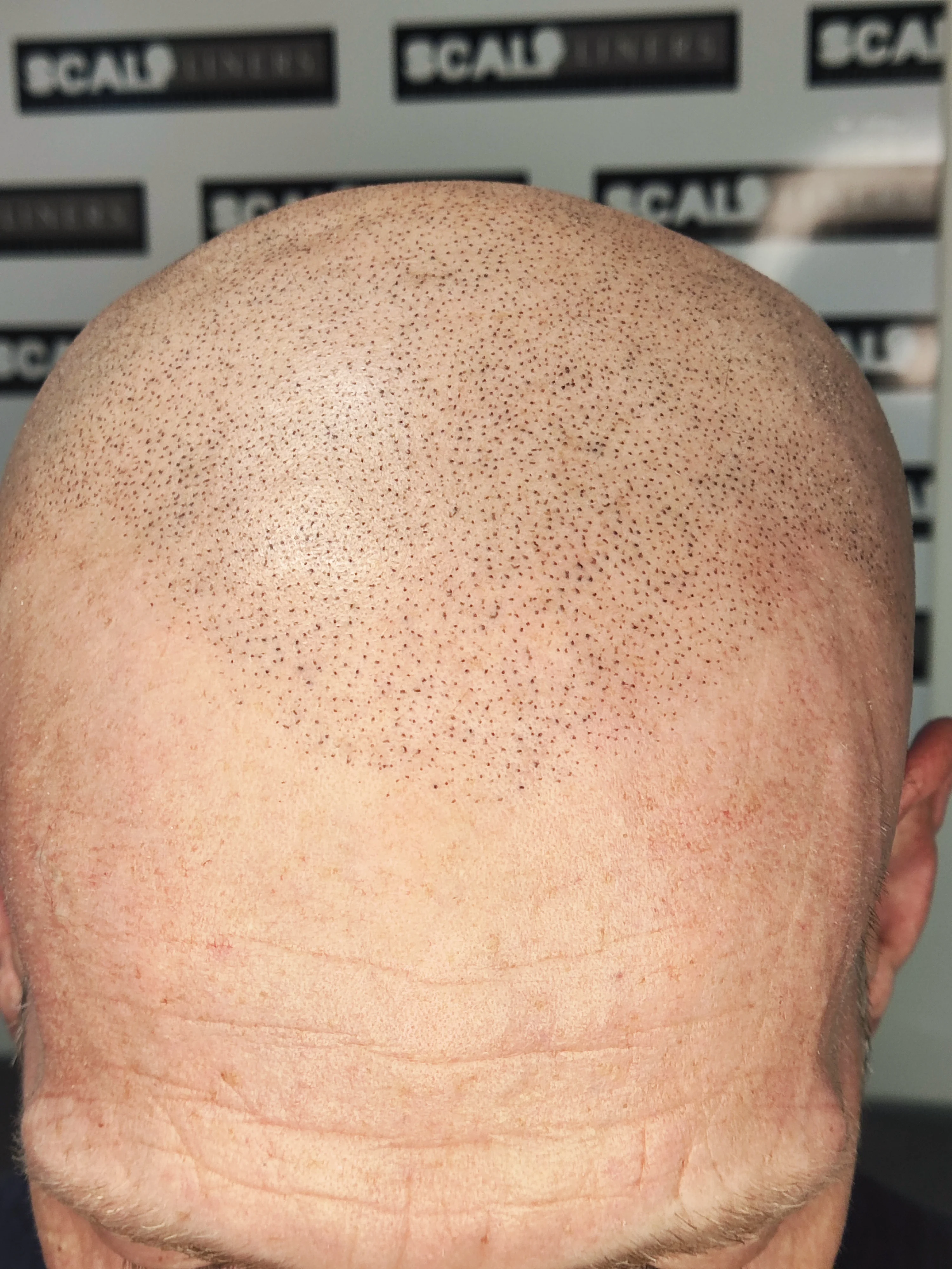 Wayne full head SMP session 2 result ScalpLiners Kent