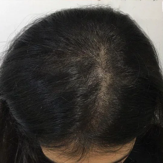 Wendy women's scalp micropigmentation result Whitstable Kent — session 3